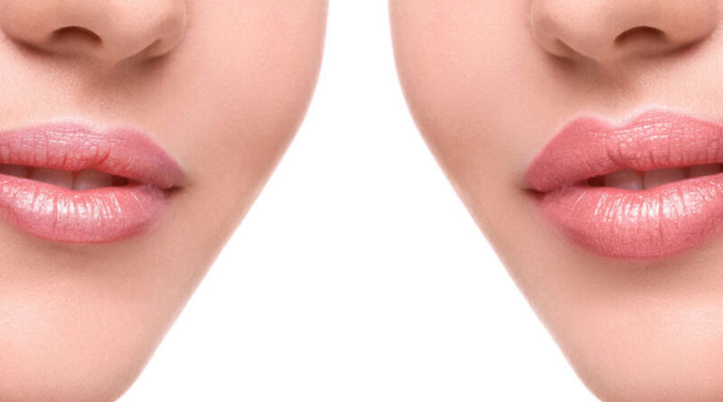 Filler Labbra Milano