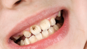 Infiammazioni dentali Genova