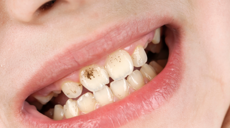 Infiammazioni dentali Genova
